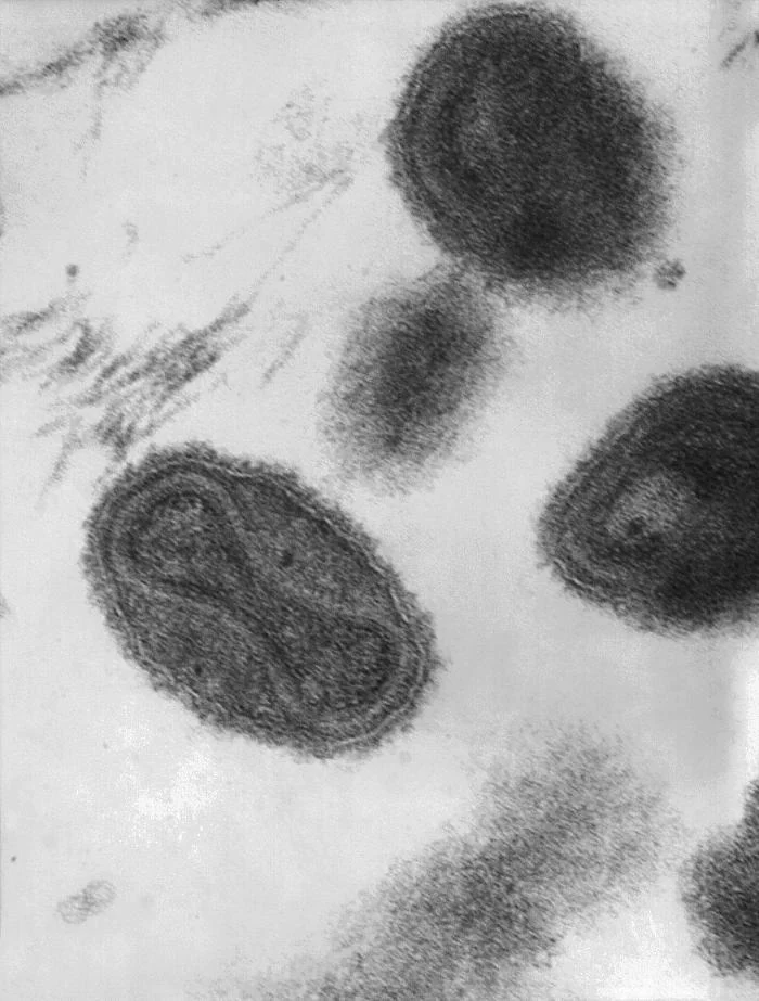 Black-and-white transmission electron micrograph of smallpox virions, including a particle with its internal viral core visible.